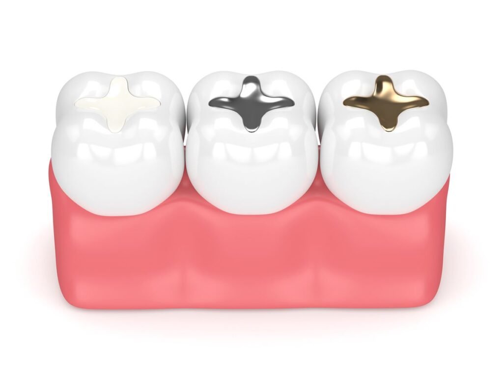 Tooth-colored fillings for kids compared with silver and gold fillings by a pediatric dentist in Bengaluru.